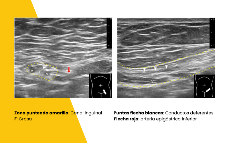 3. Hernia inguinal indirecta ecografia tempo formacion.png